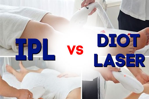 công nghệ triệt lông IPL và DIODE Laser