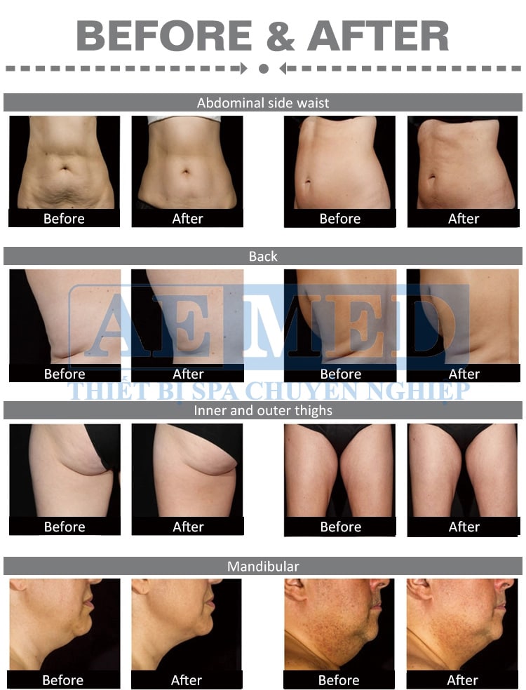 may-giam-beo-sculpsure-5