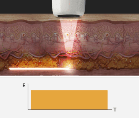 MÁY NÂNG CƠ HIFU VMAX 10 REAL LINEARV-MAX Pencilbeam HIFU
