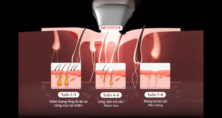 MÁY TRIỆT LÔNG P808 17